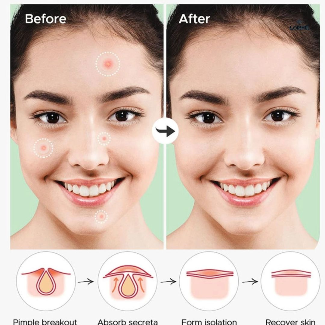 Salicylic Acid Pimple Patches (36 Pcs)
