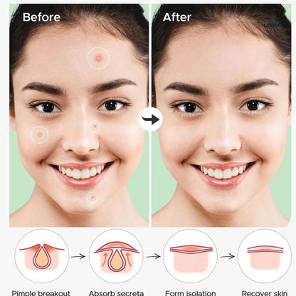 Salicylic Acid Pimple Patches (36 Pcs)