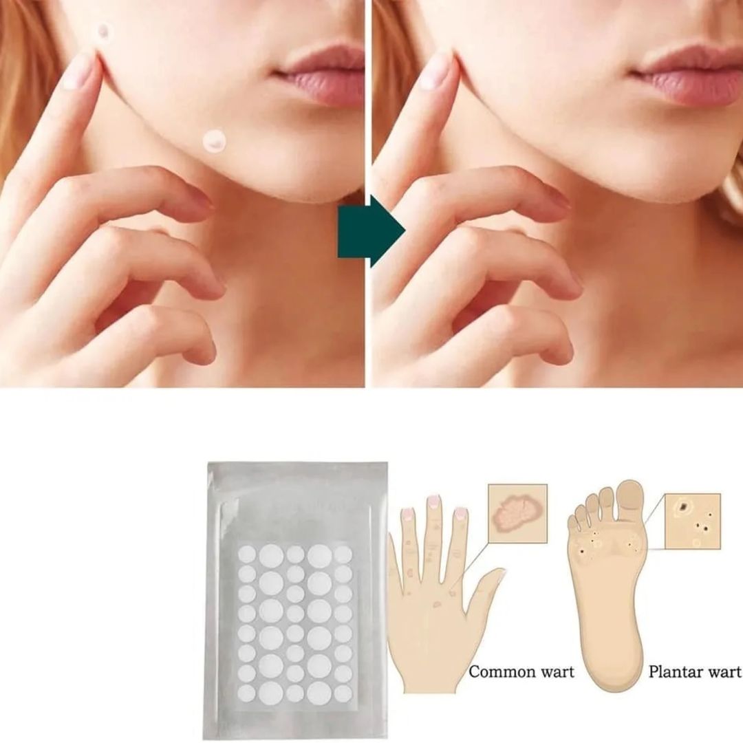 Salicylic Acid Pimple Patches (36 Pcs)