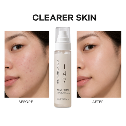 Body Acne Mist Spray